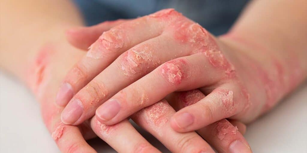 Artrite Psoriásica